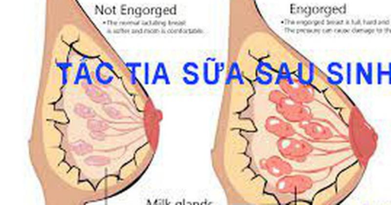 Bột nghệ chữa tắc tia sữa