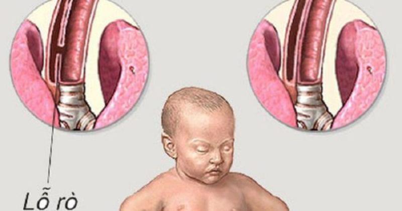 Ăn Dặm Em Bé Sơ Sinh: Khởi Đầu Cho Một Hệ Tiêu Hóa Khỏe Mạnh