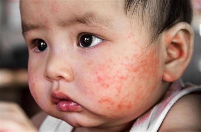 Chàm sữa ở trẻ sơ sinh: Hình ảnh minh họa