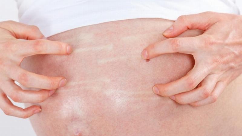 Kem Trị Rạn Da Bà Bầu: Nguyên Nhân Gây Rạn Da