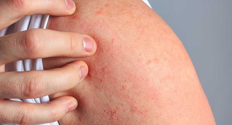 Lời khuyên cho người bị mề đay