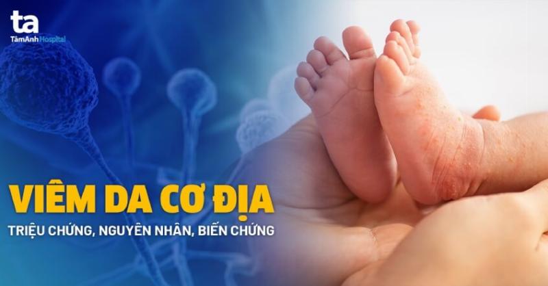 Nguyên nhân gây chàm sữa ở trẻ: Yếu tố di truyền và môi trường