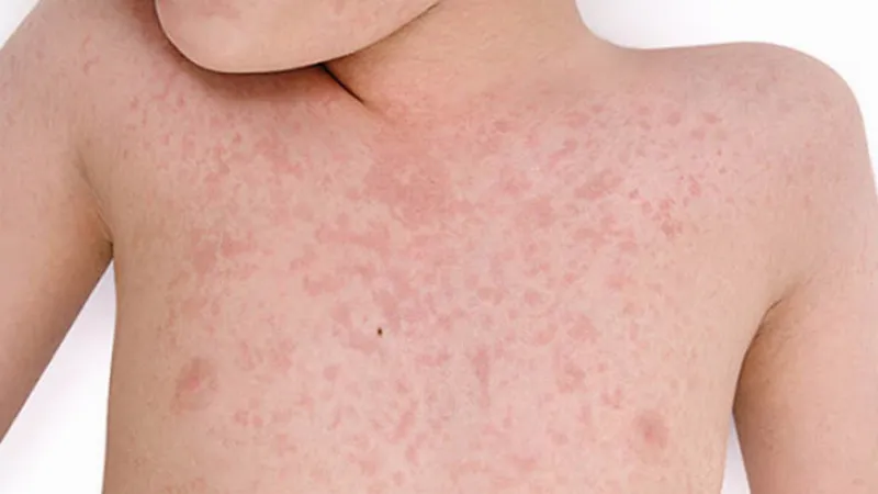 Nổi mề đay mãn tính ở trẻ em