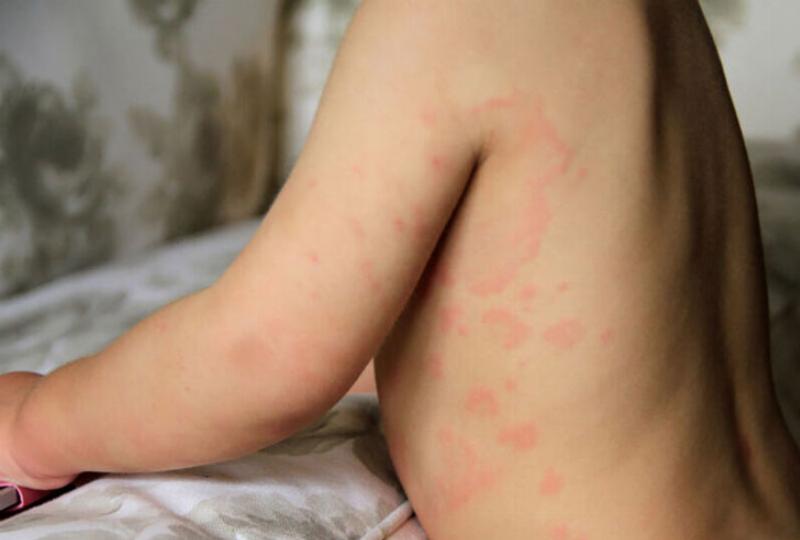 Mẹo chăm sóc da cho trẻ bị nổi mề đay