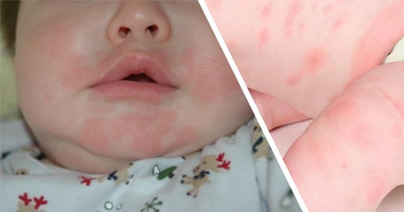 Chế độ ăn uống cho trẻ bị nổi mề đay