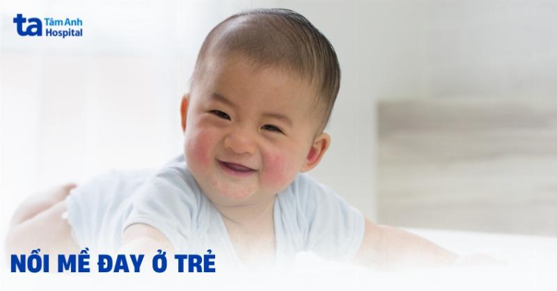 Nguyên nhân nổi mề đay ở trẻ em
