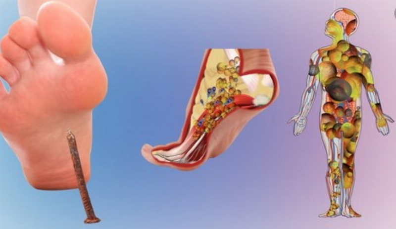 Phòng ngừa bệnh uốn ván
