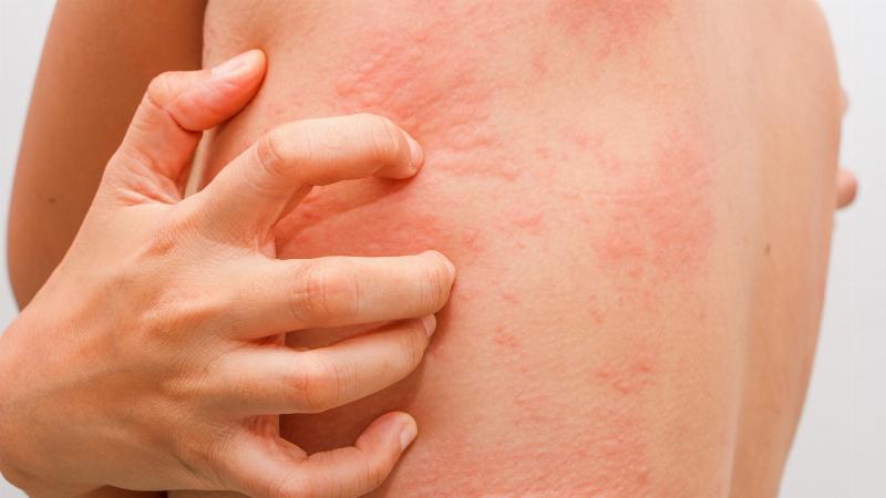 Stress và mề đay
