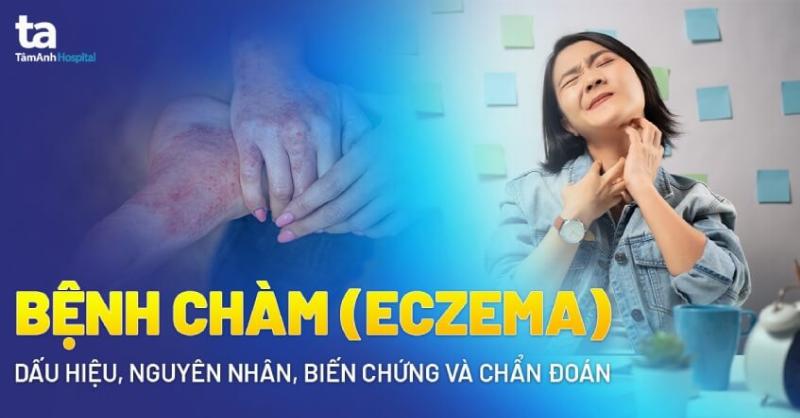Triệu chứng của chàm sữa ở trẻ: Da khô, đỏ, ngứa và mụn nước